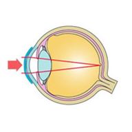 オルソケラトロジー