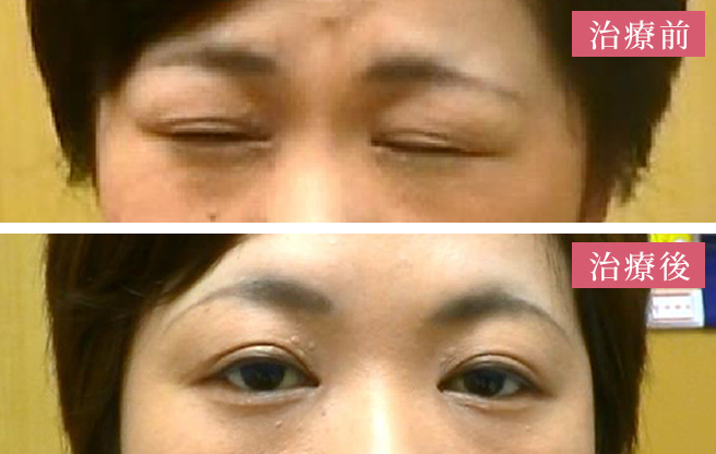 イメージ：ボトックス注射について