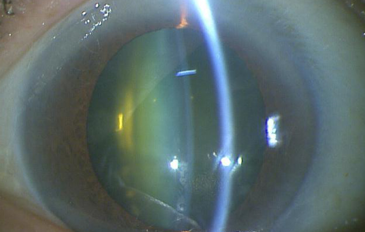 イメージ：【術前】視力0.5