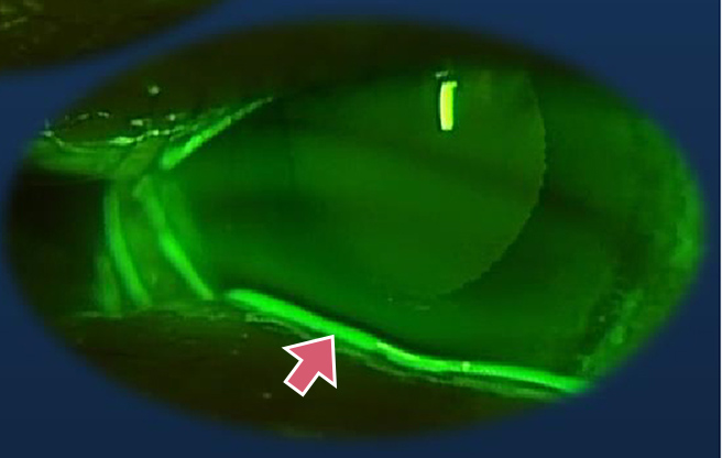 イメージ：【結膜嚢形成術後】<br>流涙症状改善、メニスカスは綺麗な一直線な形状に形状良好