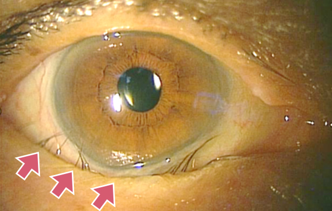 イメージ：【眼瞼内反症術前】