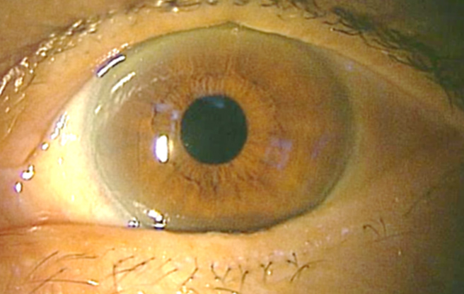 イメージ：【眼瞼内反症術後】流涙、異物感が改善されました。