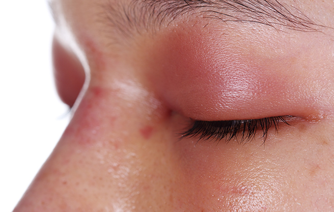 イメージ：ものもらい、めいぼ