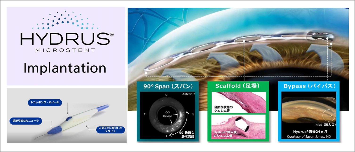 イメージ：水晶体再建術併用眼内ドレーン挿入術（HYDRUS® Microstent Implantation）