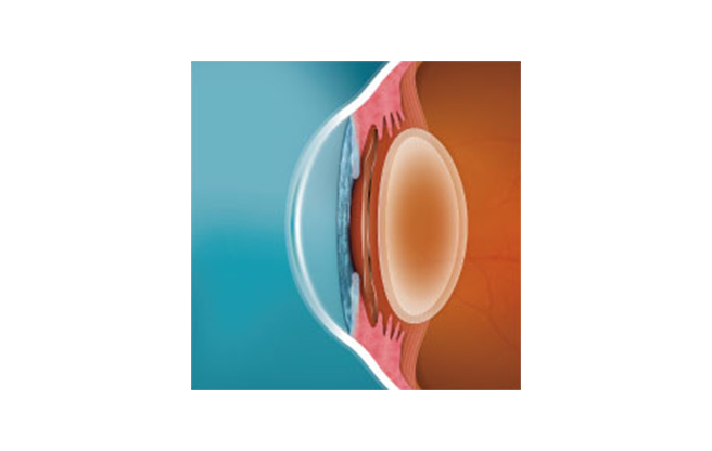 イメージ：虹彩と水晶体の間に固定