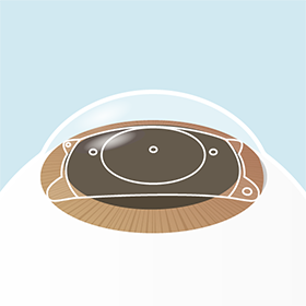 イメージ：手術の流れ2