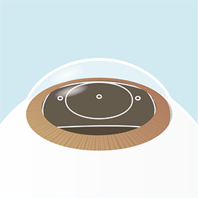 イメージ：手術の流れ3