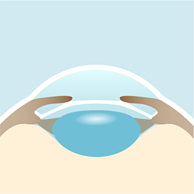 イメージ：手術の流れ5