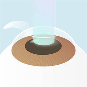 イメージ：手術の流れ4