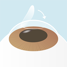 イメージ：手術の流れ5