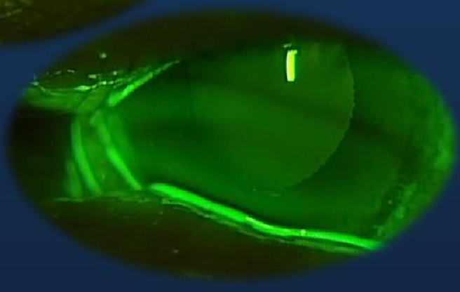 イメージ：流涙症(なみだ目)・内反症