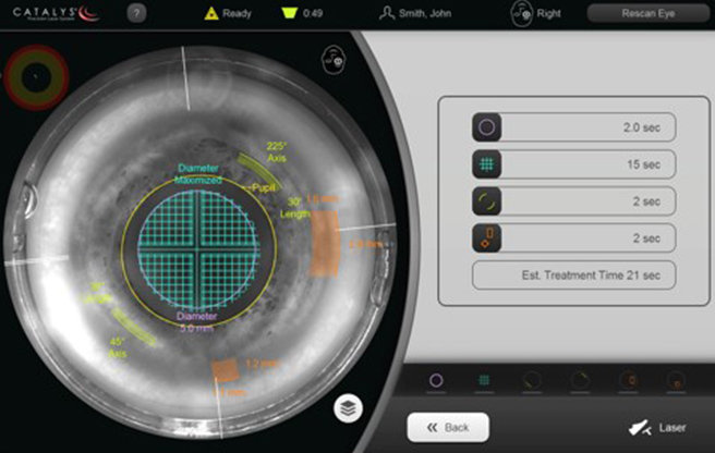 イメージ：レーザー白内障手術