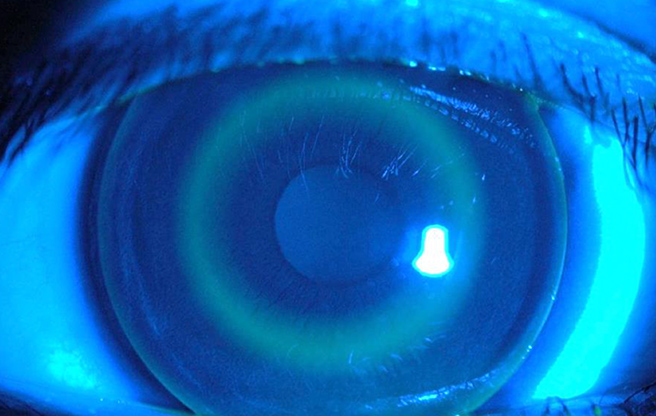 イメージ：オルソケラトロジー