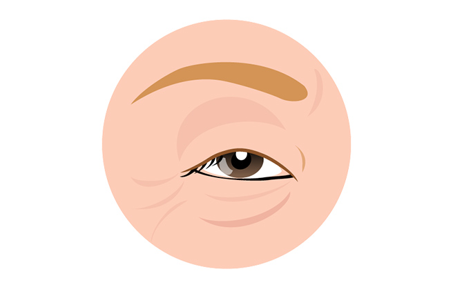 イメージ：眼瞼下垂手術