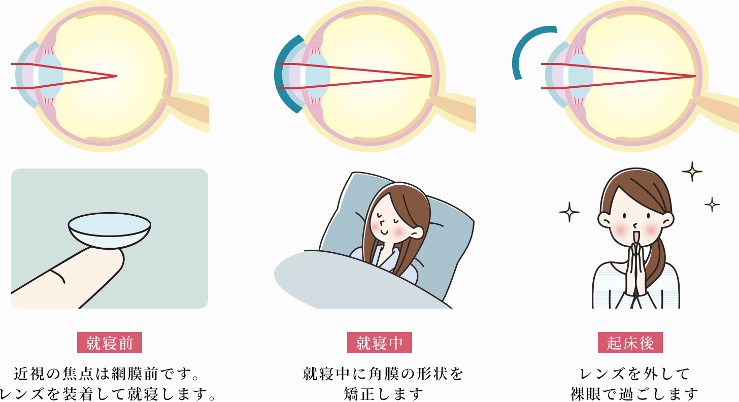 イメージ：オルソケラトロジー(近視矯正)について