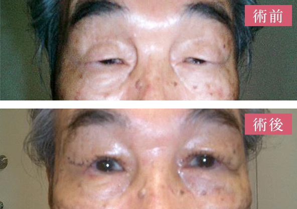 イメージ：【加齢性眼瞼下垂】挙筋短縮術後1週間、抜糸前