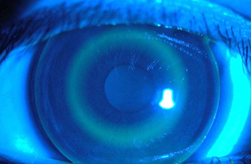 イメージ：オルソケラトロジー