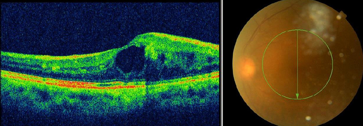 イメージ：黄斑浮腫、硝子体出血を合併しています。