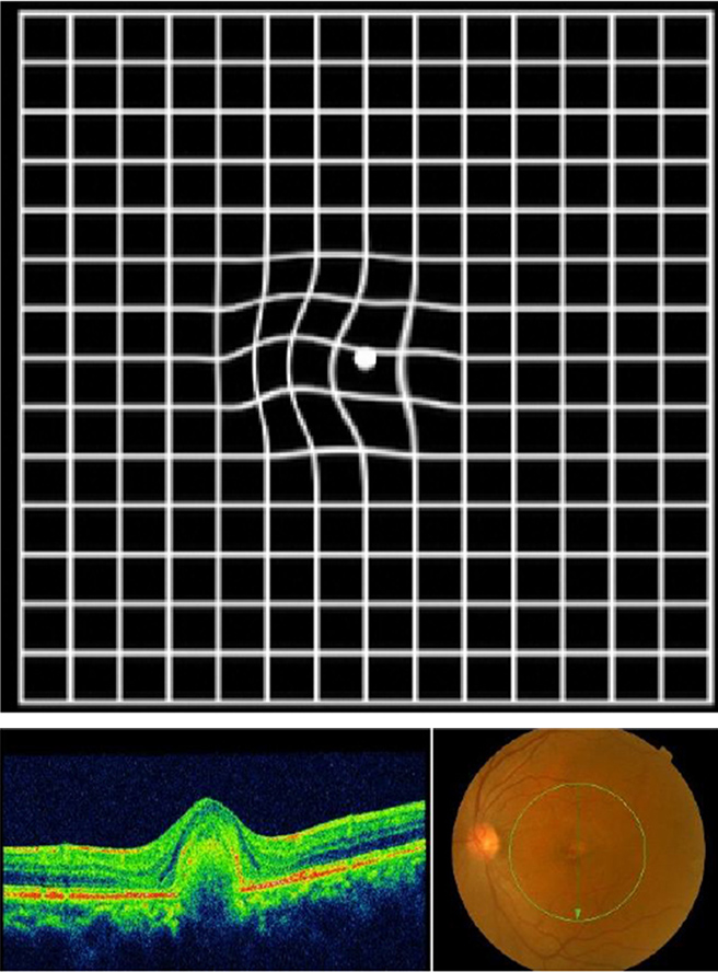 イメージ：加齢性黄斑変性
