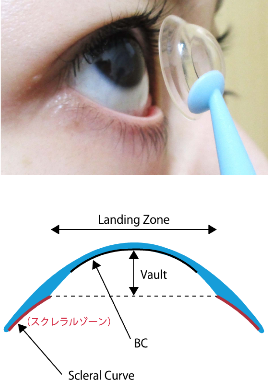 イメージ：スクレラルレンズとは