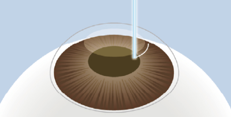 イメージ：小切開の作成